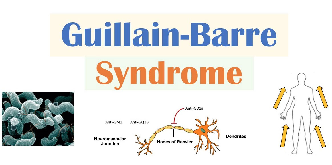 Guillain Barre Syndrome Treatment | Guillain Barre Treatment - Vansh Health  Care